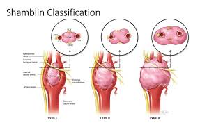 Carotid body tumors [upl. by Cornela]