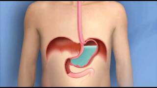 Heartburn Acid Reflux GERDMayo Clinic [upl. by Damicke]