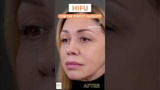 HIFU Treatment Before amp After hifutreatment hifufacial hifufacelifting facelift [upl. by Ynnad358]