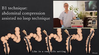 Colonoscopy Insertion Technique with Mikoto Model How to use abdominal compression [upl. by Kean]