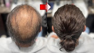 These BALDING to LONG HAIR Look TRANSFORMATIONS Are MIND BLOWING [upl. by Thelma314]