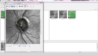 Case Study with SPECTRALIS OCT Glaucoma [upl. by Atirrehs253]