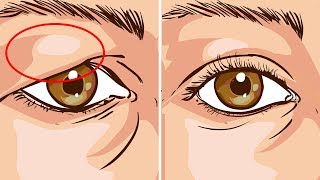 How To Treat Droopy Eyelids Naturally The Results Are Amazing [upl. by Ellicec]