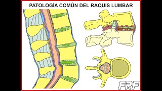 Patología común del raquis lumbar [upl. by Nihcas]