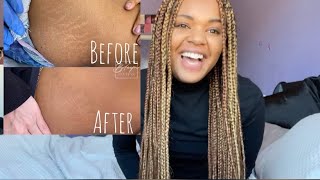 My stretch mark removal [upl. by Onitnatsnoc604]