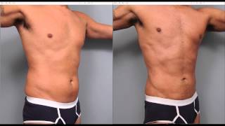 The Benefits of Liposuction for Men  Dr Sterry Explains [upl. by Elleinaj356]