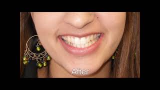 Invisalign for Adults A Better Way to a Straighter Smile [upl. by Thorstein]