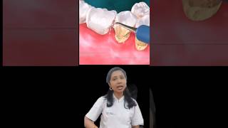 Teeth Cleaning Or Teeth Bleaching trending shortfeed dentist teethwhitening teethcleaning dr [upl. by Light]