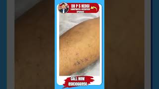 Best Chiropractor in KolkataLower Cuff Muscle Pain Treatment by Dr PS Neogi shorts [upl. by Ytirehc]