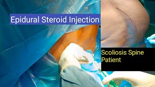 EPIDURAL STEROID INJECTIONS SCOLIOSIS SPINE epidural viralvideo anesthesia doctor english [upl. by Rennob]