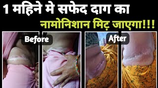 Vitiligoसफेद दाग इससे असरदार 💯 आयुर्वेदिक इलाज ना है ना होगा❗Vitiligo treatment।।White patches dawa [upl. by Canon]