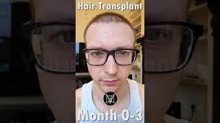 Hair Transplant growth Timeline 03 Months [upl. by Atterehs257]