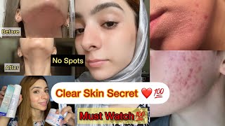 Clear aur glowing skin milegi सिर्फ 1 hafte मैं Guaranteed  get rid of pimples acne dark spots [upl. by Lleznov492]