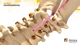 Óssea Medical Technology Sistema OccipitoCervical [upl. by Adelaide]