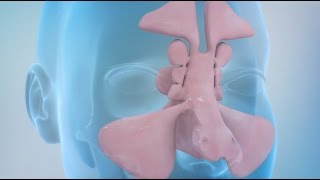 Sinusitis and Sinus Surgery Explained Balloon Sinuplasty and Endoscopic Sinus Surgery [upl. by Restivo]