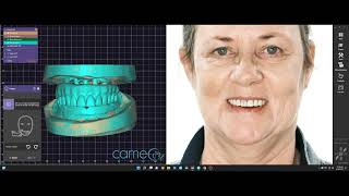 Exocad Design  Fixed Implant Screw Retained PMMA Prototype Maxilla and a Milled PMMA Immediate Dent [upl. by Cresa]