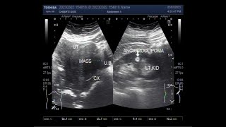 A large Fibroid and a small Renal Angiomyolipoma [upl. by Shaner]