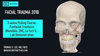 ORIF ZMC Mandible Bilat Le Fort 1 Fx Ex Fix 201B Lab Demo [upl. by Margarette]