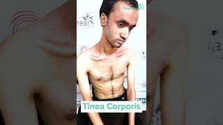 Tinea Corporis  Testimonial  Dhaka Dermatology Institute [upl. by Fineman]