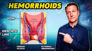 The 1 Best Remedy for Hemorrhoids  Dr Berg [upl. by Sim]