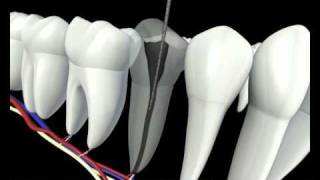 Root Canal Procedure 3D Animation  Endodontics Los Angeles [upl. by Ynaffyt]