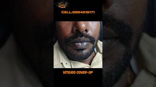 Vitiligo vitiligo lips vitiligo causes vitiligo treatment vitiligo hospital vitiligo skin [upl. by Nalyad]