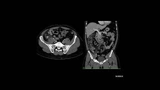 Case of the Week The most likely dx in this pt with RLQ pain is [upl. by Ecnesse]