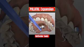 PALATAL EXPANDER  Expansion of upper jaw after several weeks [upl. by Nisa]