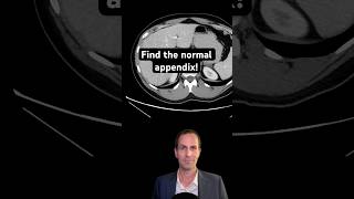 Abdominal CT Tutorials  Find the Normal Appendix [upl. by Cotter]