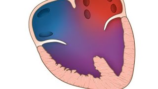 Hydrops fetalis because of cardiac anomaly  Atrioventricular septal defects AVSDs [upl. by Anauqes885]