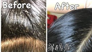 Remove 100 Lice amp Eggs Permanently with Hair Sheild Anti lice Cream 49 Rs  Farha KHan [upl. by Aziar]