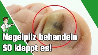 Nagelpilz behandeln  SO klappt es 👣💅 [upl. by Odeen]