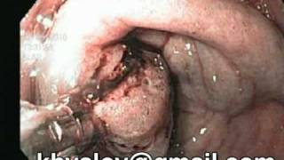 Adenomatous polyp of pyloric Endoscopic diagnosis [upl. by Noah499]