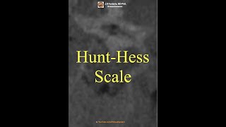 Subarachnoid Hemorrhage HuntHess Scale [upl. by Inan]