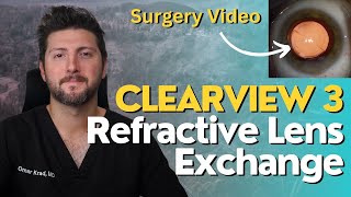 Refractive Lens Exchange RLE Surgery with the Clearview 3 Lens [upl. by Kaile683]