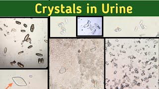 Identify Urine crystals  Crystals in Urine under Microscope  Urine Microscopic Examination [upl. by Odyssey160]