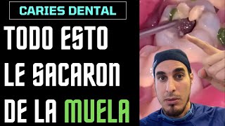 ¿Qué es todo esto que le sale de un AGUJERO en la MUELA  CARIES DENTAL [upl. by Ahtelat]