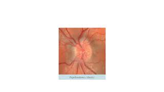 Papilloedema optic atrophy Opthal final [upl. by Niamrej]