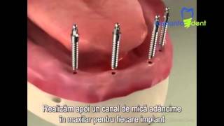 Implants Mini Implant Overdenture Procedure [upl. by Naerol]