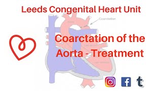 Coarctation of the Aorta  Treatment [upl. by Coulombe]