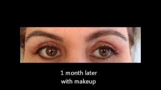 Blepharoplasty Upper eyelid lift surgery  recovery story [upl. by Lengel]