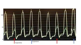 Hemodynamics Constrictive pericarditis cases mechanisms technical tips Elias Hanna Univ of Iowa [upl. by Isac]