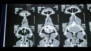 HOW TO READ A CT  PNS Paranasal sinuses made simple  DrAjinkya Kedari [upl. by Marcela]