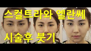 스컬트라 스컬트라붓기 엘란쎄 엘란쎄붓기 스컬트라와 엘란세의 붓기차이 [upl. by Anderegg]