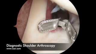 Basic Shoulder Arthroscopy [upl. by Leftwich]