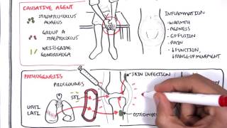 Septic Arthritis  Overview causes pathophysiology treatment [upl. by Ogeid813]