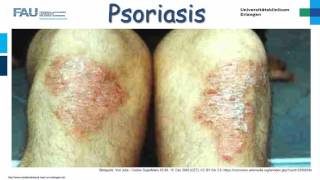 Dermatologie ─ Psoriasis [upl. by Sibelle]