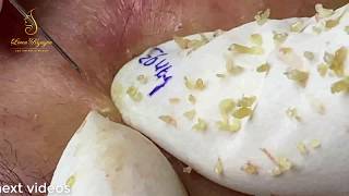 BLACKHEADS TREATMENT 93  Loan Nguyen [upl. by Llecrup431]