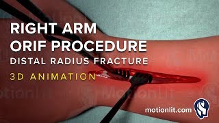 Right Arm ORIF Procedure of Distal Radius Fracture  3D Medical Animation [upl. by Einegue]