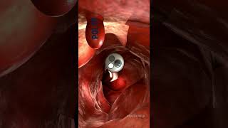 ENDOSCOPIC PROCEDURE  Endoscopic view of our Intestine 🧑‍⚕️healthfield medicineknowledge [upl. by Enahpad]